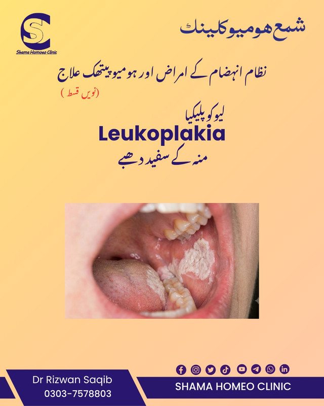 Leukoplakia منہ کے سفید دھبے 