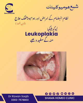 Leukoplakia منہ کے سفید دھبے 