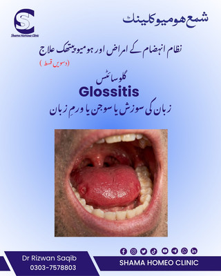 Glossitis زبان کی سوزش 