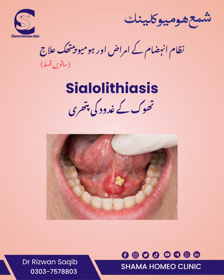 Sialolithiasis Salivary Gland Stones