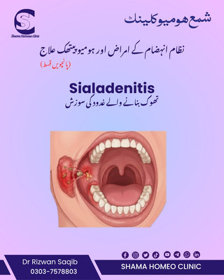 Sialadenitis تھوک کے غدود کی سوزش 
