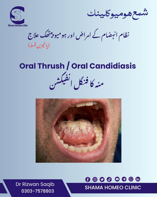 Oral Candidiasis فنگل انفیکشن 