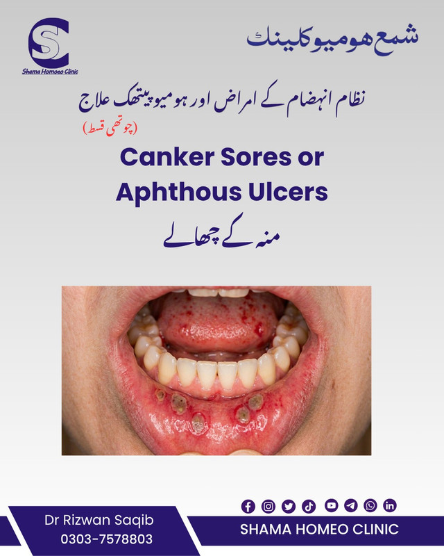 Aphthous Ulcers  یا Canker Sores