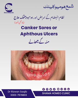 Aphthous Ulcers  یا Canker Sores