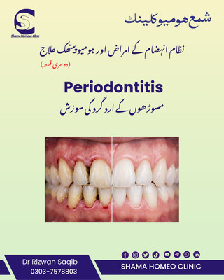 Periodontitis پیریاڈونٹائٹس 