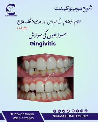 Gingivitis مسوڑھوں کی سوزش 